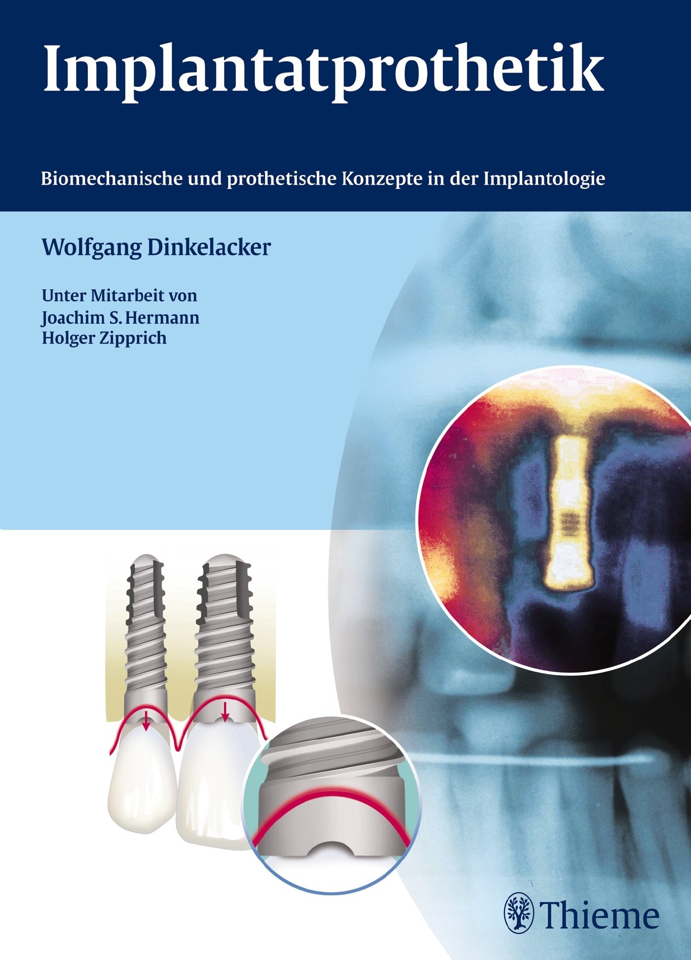 Implantatprothetik: Biomechanische und prothetische Konzepte in der Implantologie book