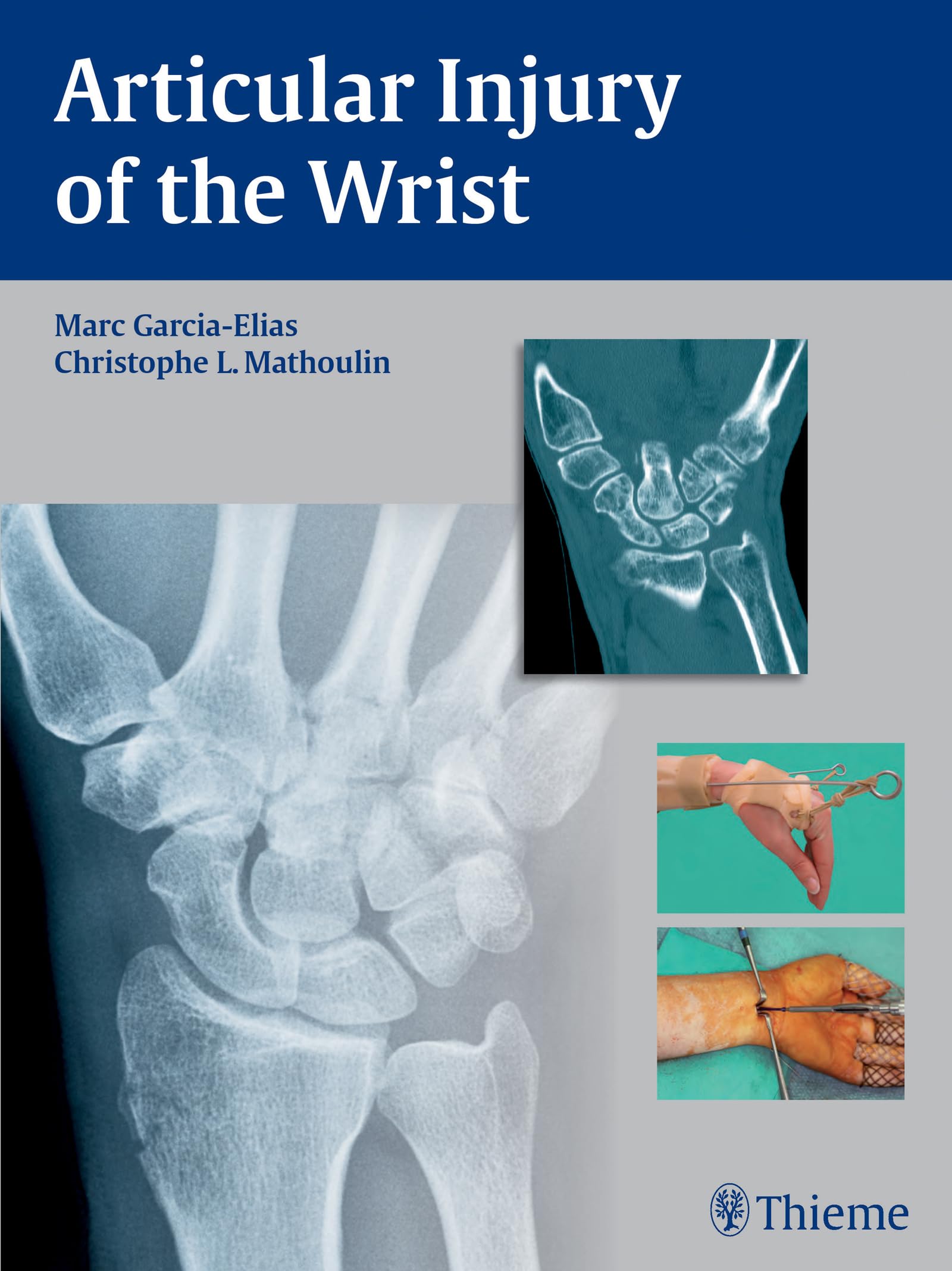 Articular Injury of the Wrist: FESSH 2014 Instructional Course Book Medicine