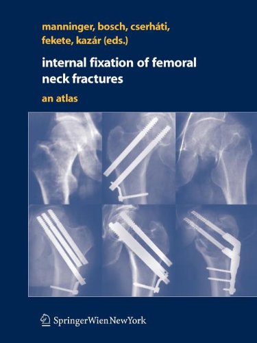 Internal fixation of femoral neck fractures Books
