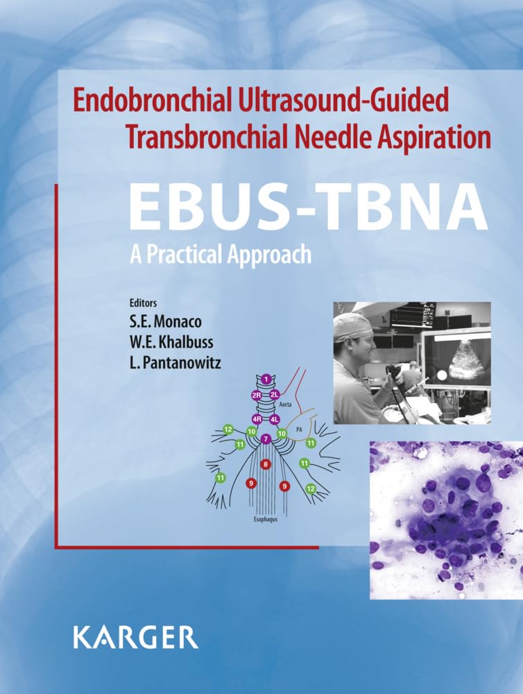 Endobronchial Ultrasound-Guided Transbronchial Needle Aspiration (EBUS-TBNA): A Practical Approach Medicine