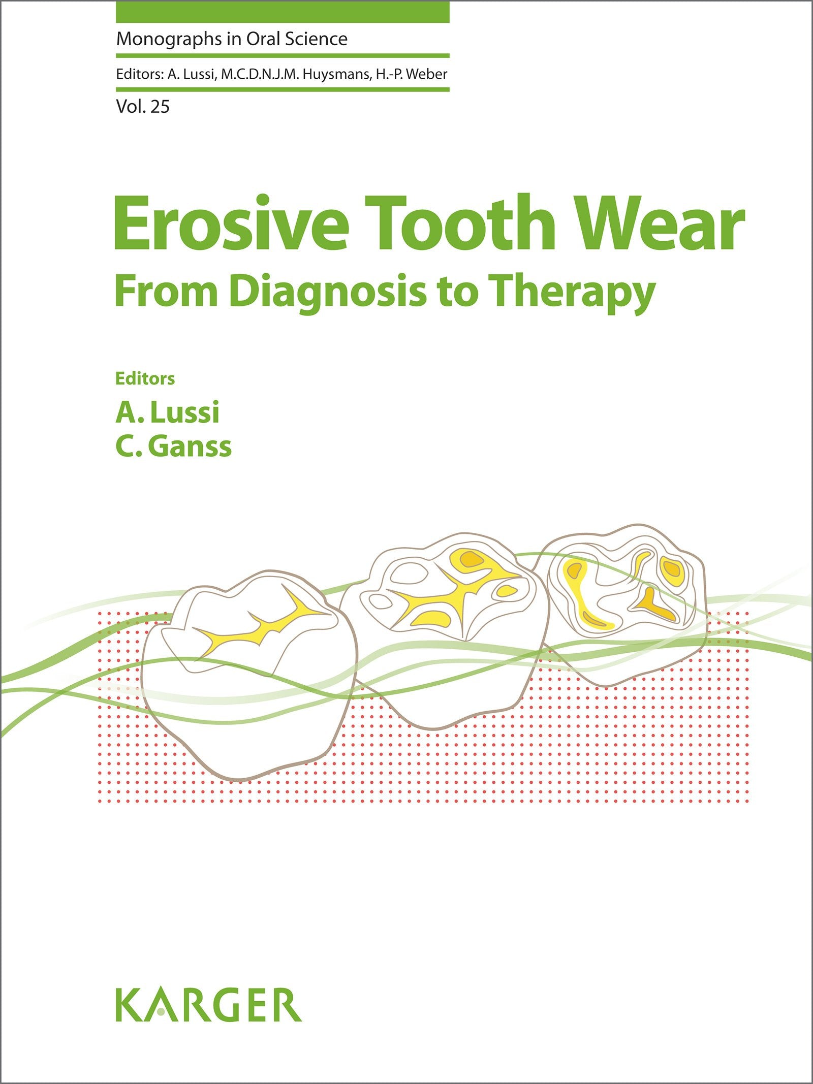 Erosive Tooth Wear: From Diagnosis to Therapy (Monographs in Oral Science, Band 25) Medicine