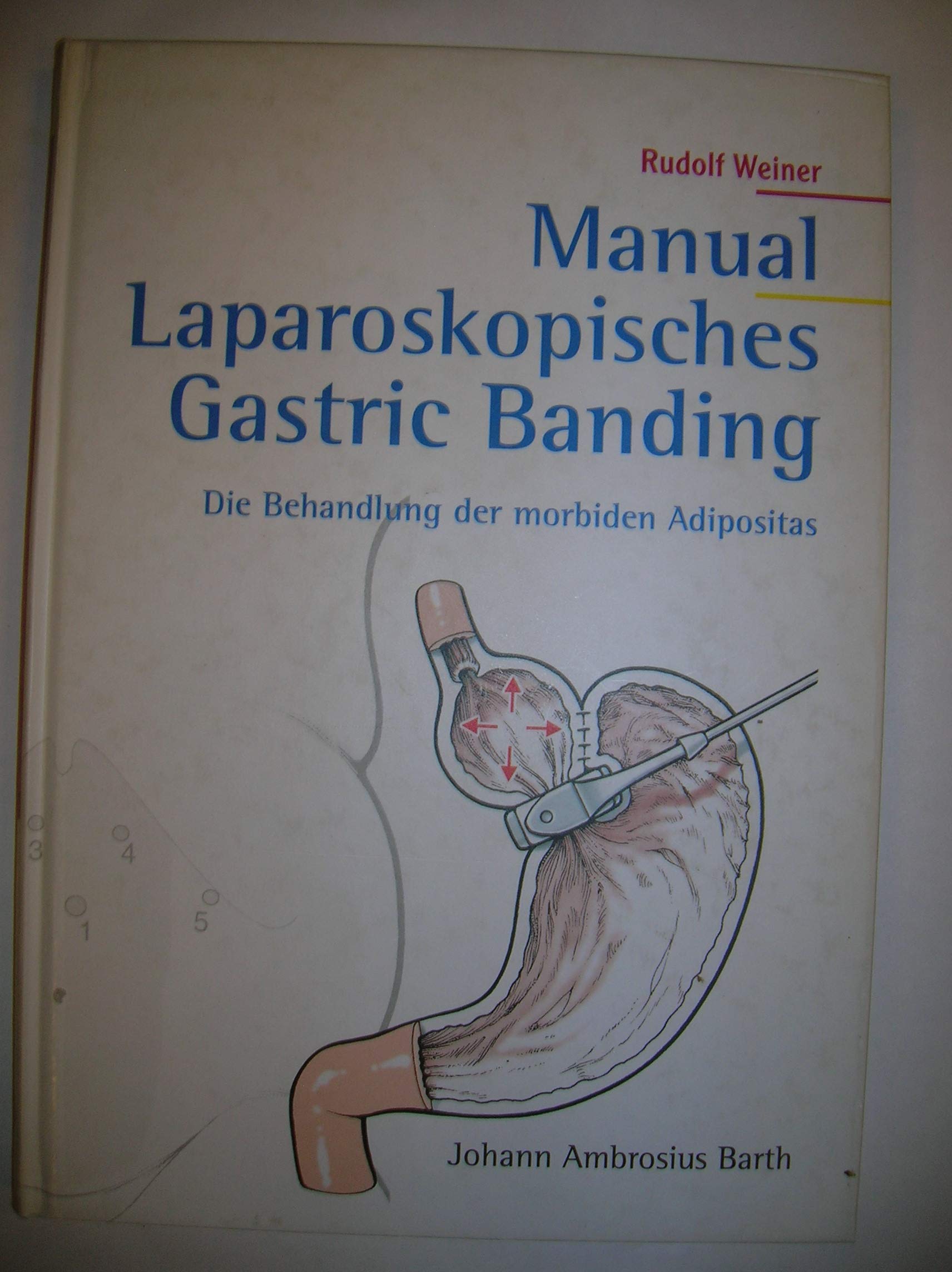 Manual Laparoskopisches Gastric Banding. Die Behandlung der morbiden Adipositas Medicine
