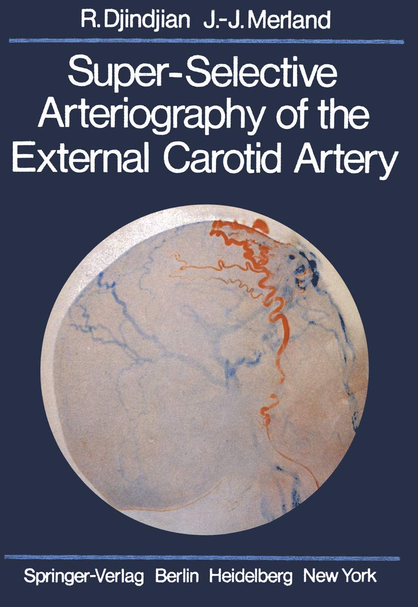 Super-Selective Arteriography of the External Carotid Artery Medicine