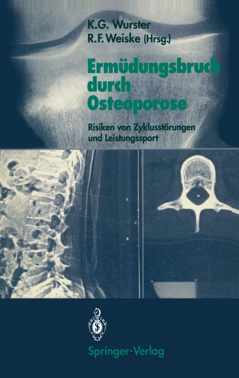 Ermüdungsbruch durch Osteoporose: Risiken von Zyklusstörungen und Leistungssport (German Edition) Medicine