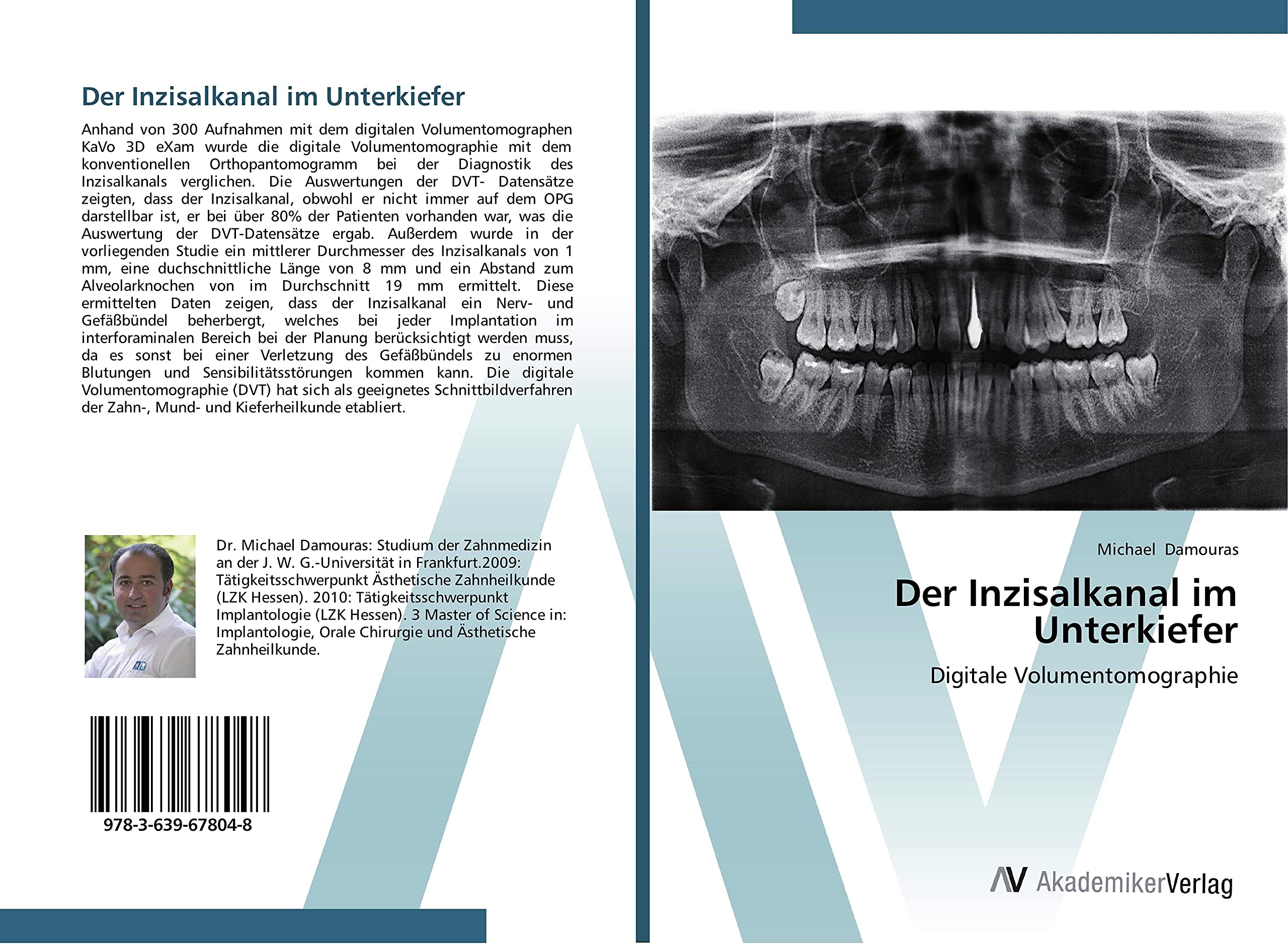 Der Inzisalkanal im Unterkiefer: Digitale Volumentomographie Medicine
