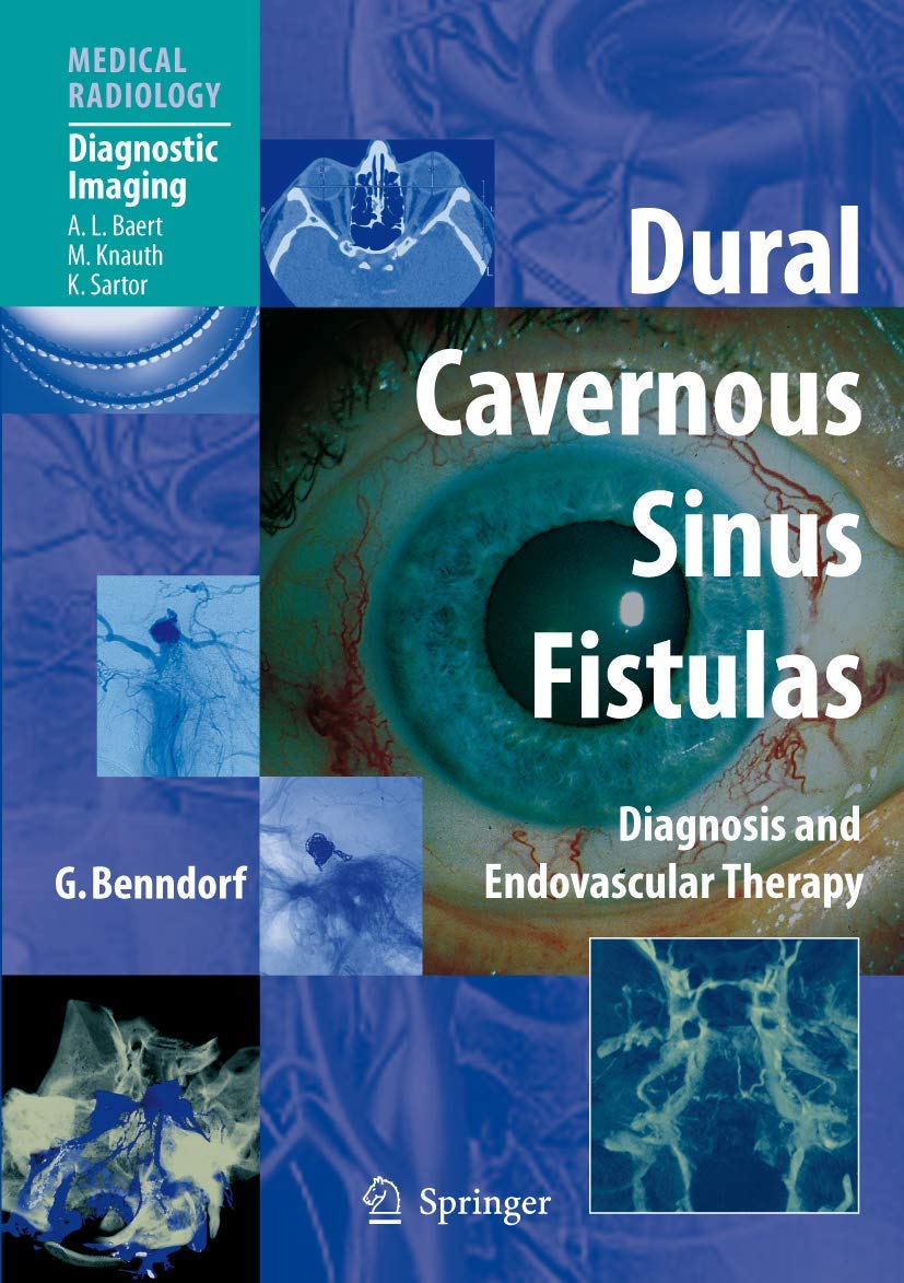 Dural Cavernous Sinus Fistulas: Diagnosis and Endovascular Therapy (Medical Radiology) Medicine