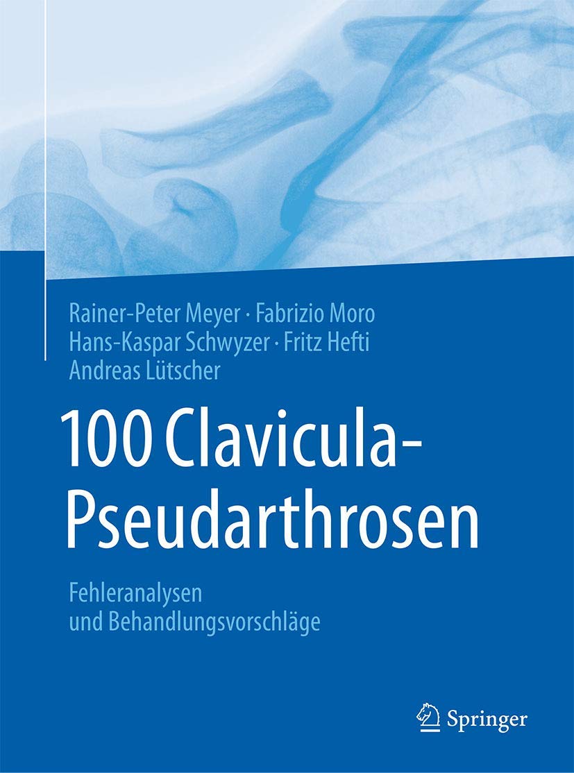 100 Clavicula-Pseudarthrosen: Fehleranalysen und Behandlungsvorschläge Medicine