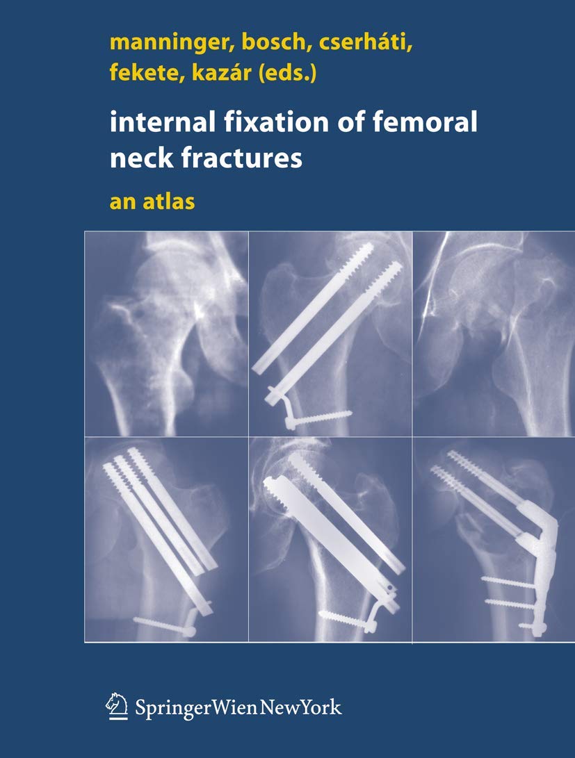 Internal fixation of femoral neck fractures: An Atlas Medicine