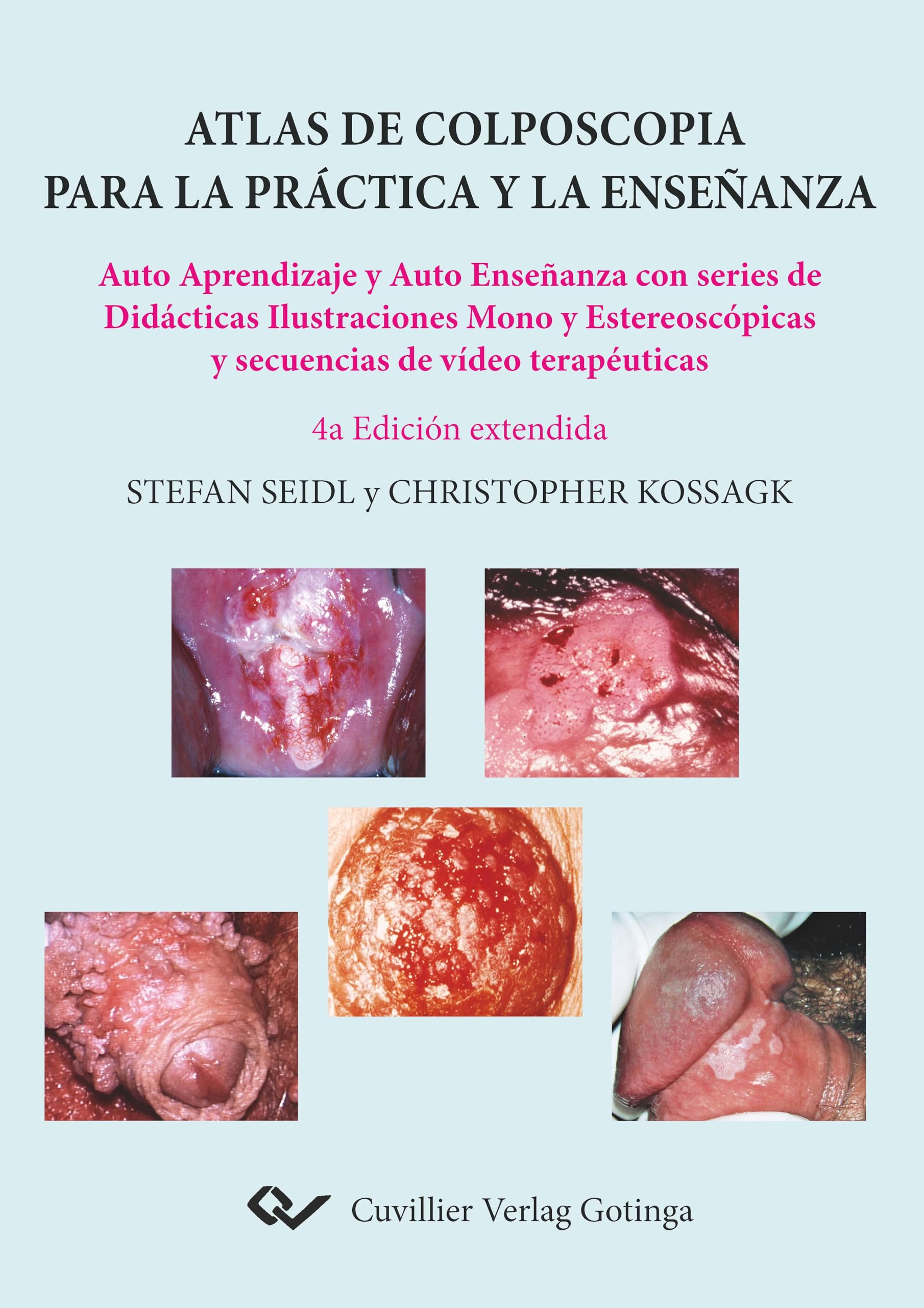 Atlas de colposcopia para la práctica y la enseñanza. Auto Aprendizaje y Auto Enseñanza con series de Didácticas Ilustraciones Mono y Estereoscópicas y secuencias de vídeo terapéuticas Medicine