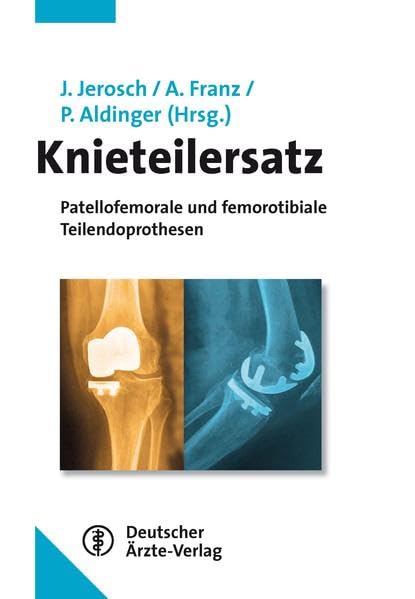Knieteilersatz: Patellofemorale und femorotibiale Teilendoprothesen Medicine