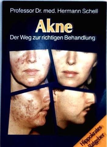 Akne. Der Weg zur richtigen Behandlung Health, Nutrition & Fitness