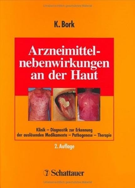 Arzneimittelnebenwirkungen an der Haut: Klinik - Diagnostik zur Erkennung der auslösenden Medikamente - Pathogenese - Therapie Medicine