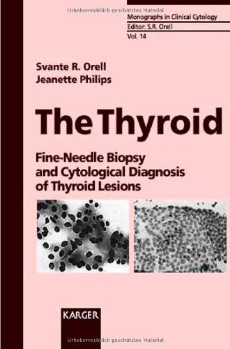 The Thyroid: Fine-Needle Biopsy and Cytological Diagnosis of Thyroid Lesions book