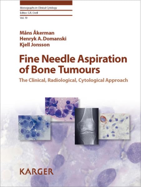 Fine-Needle Aspiration of Bone Tumors Medicine