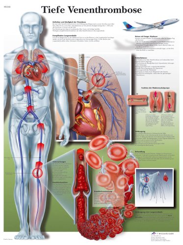 Product Image: Tiefe Venenthrombose
