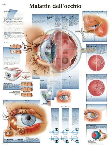 Malattie dell'occhio (Anatomische Lehrtafeln zu diversen medizinischen Themen) Medicine