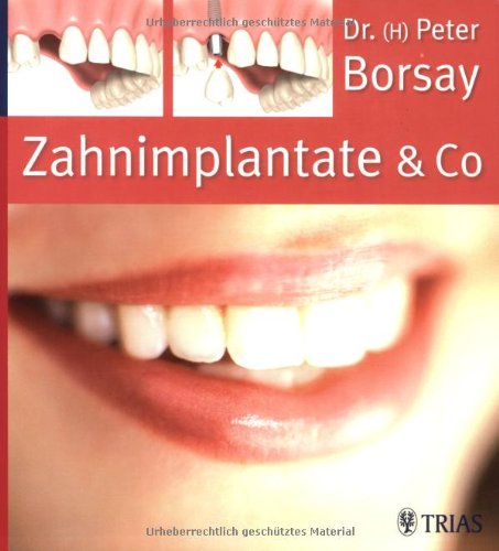 Zahnimplantate & Co.: Die Implantologie in der modernen Zahnheilkunde Medicine