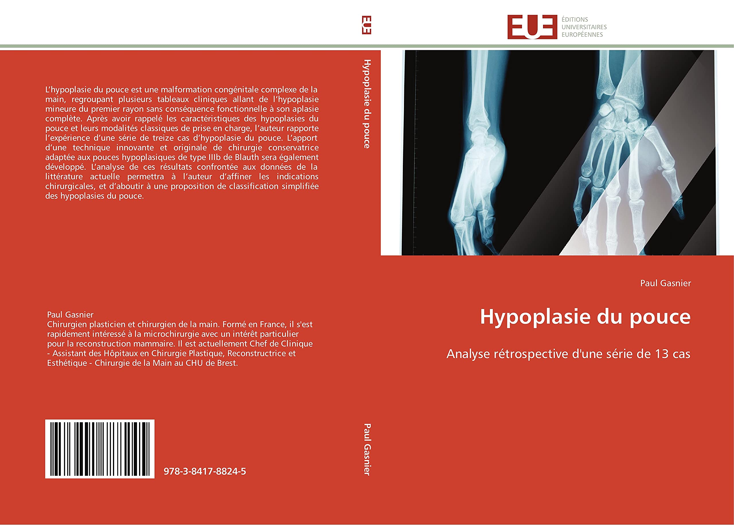 Hypoplasie du pouce: Analyse rétrospective d'une série de 13 cas book