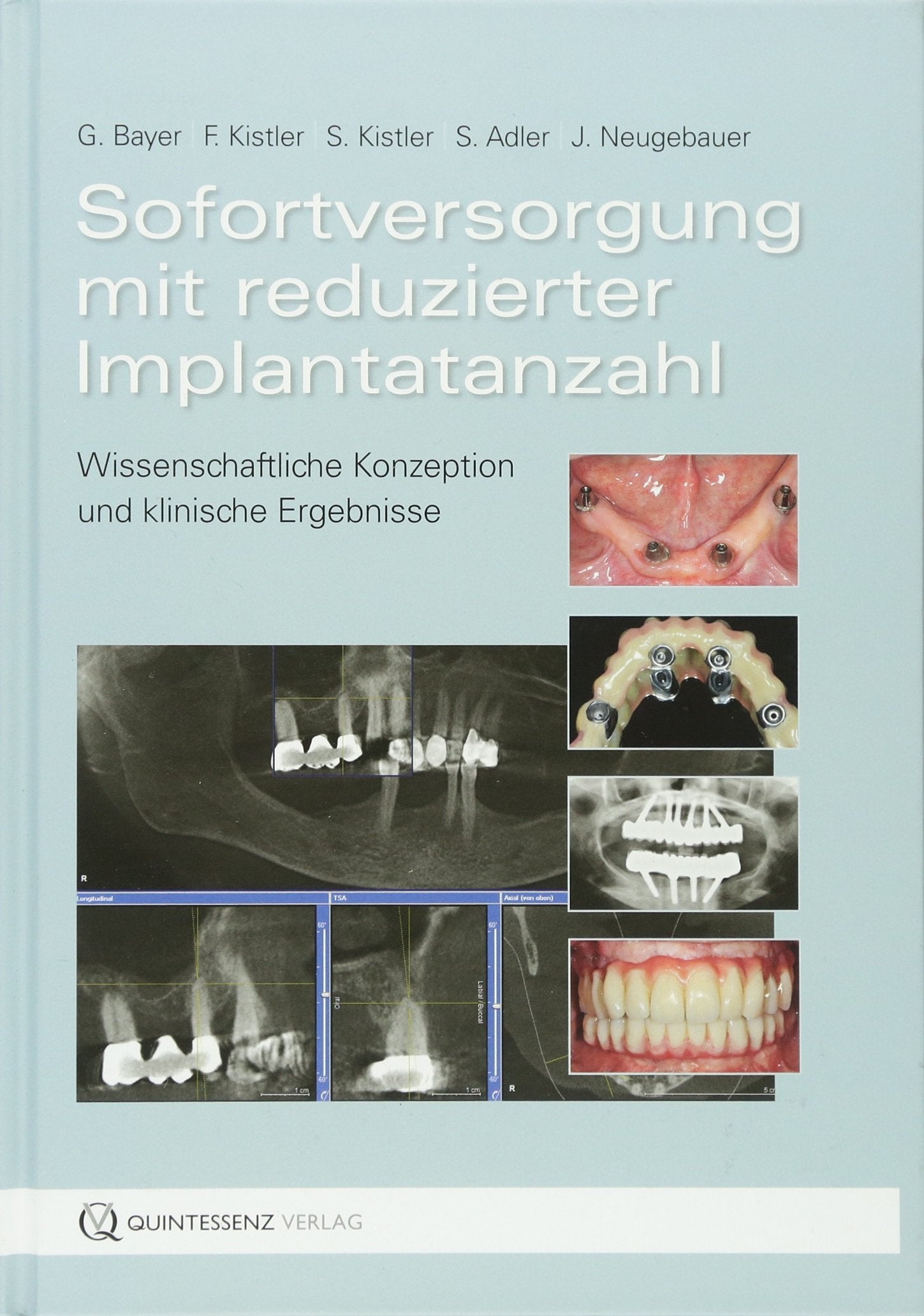 Sofortversorgung mit reduzierter Implantatanzahl Medicine