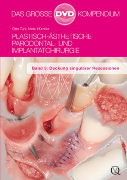 Plastisch-Ästhetische Parodontal- und Implantatchirurgie: Band 3: Deckung singulärer Rezessionen Films