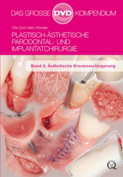 Plastisch-Ästhetische Parodontal- und Implantatchirurgie: Band 5: Ästhetische Kronenverlängerung Movies