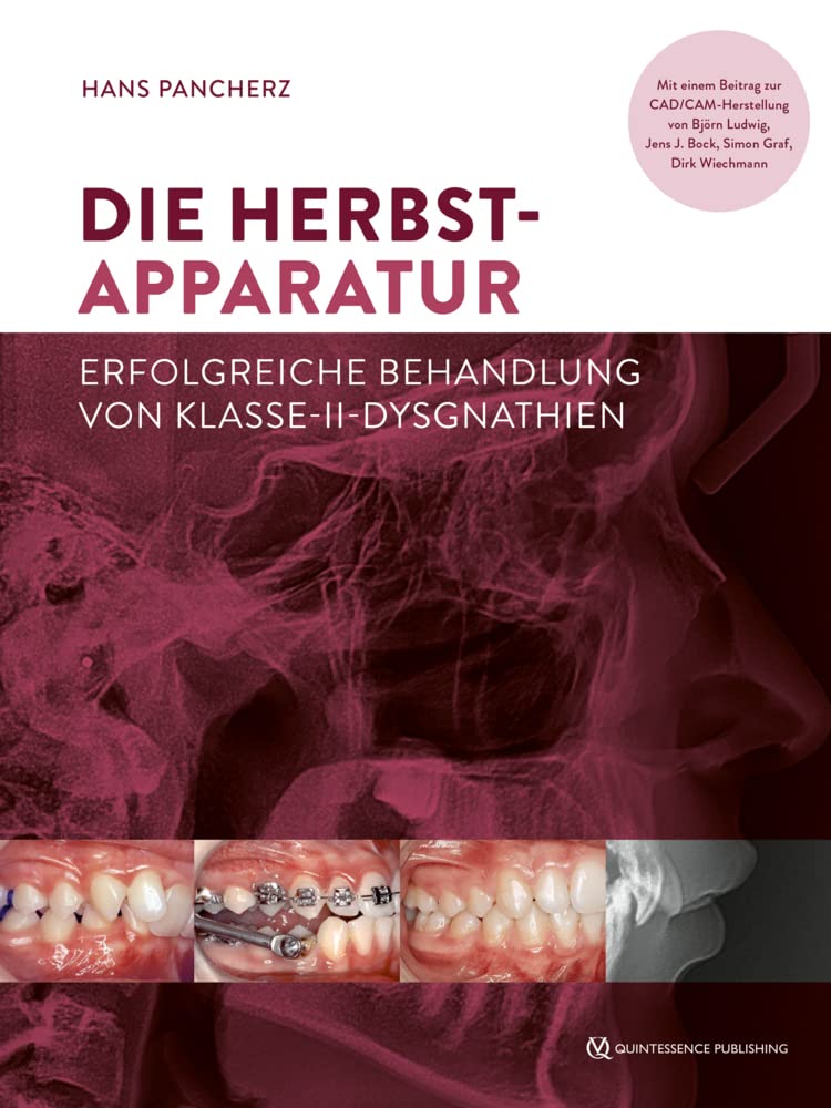 Die Herbst-Apparatur: Erfolgreiche Behandlung von Klasse-II-Dysgnathien Medicine