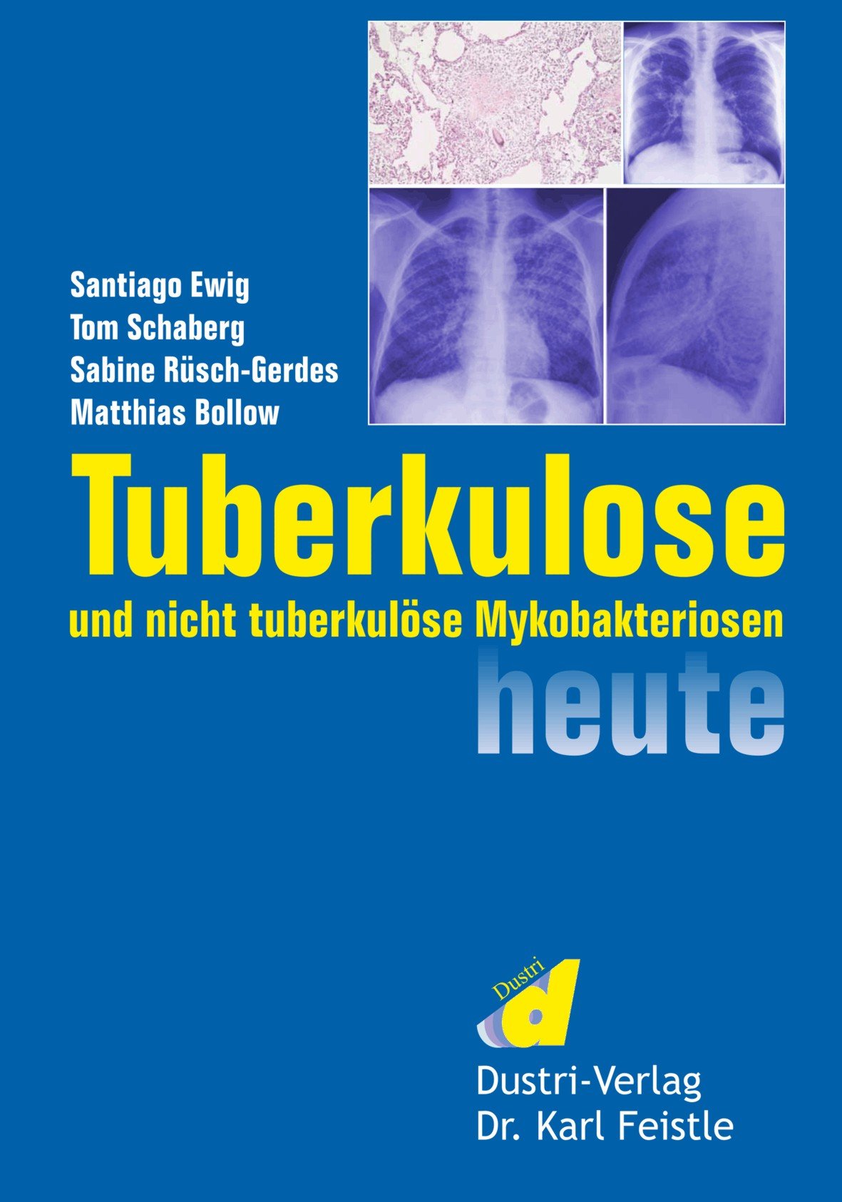 Tuberkulose und nicht tuberkulöse Mykobakteriosen heute Medicine