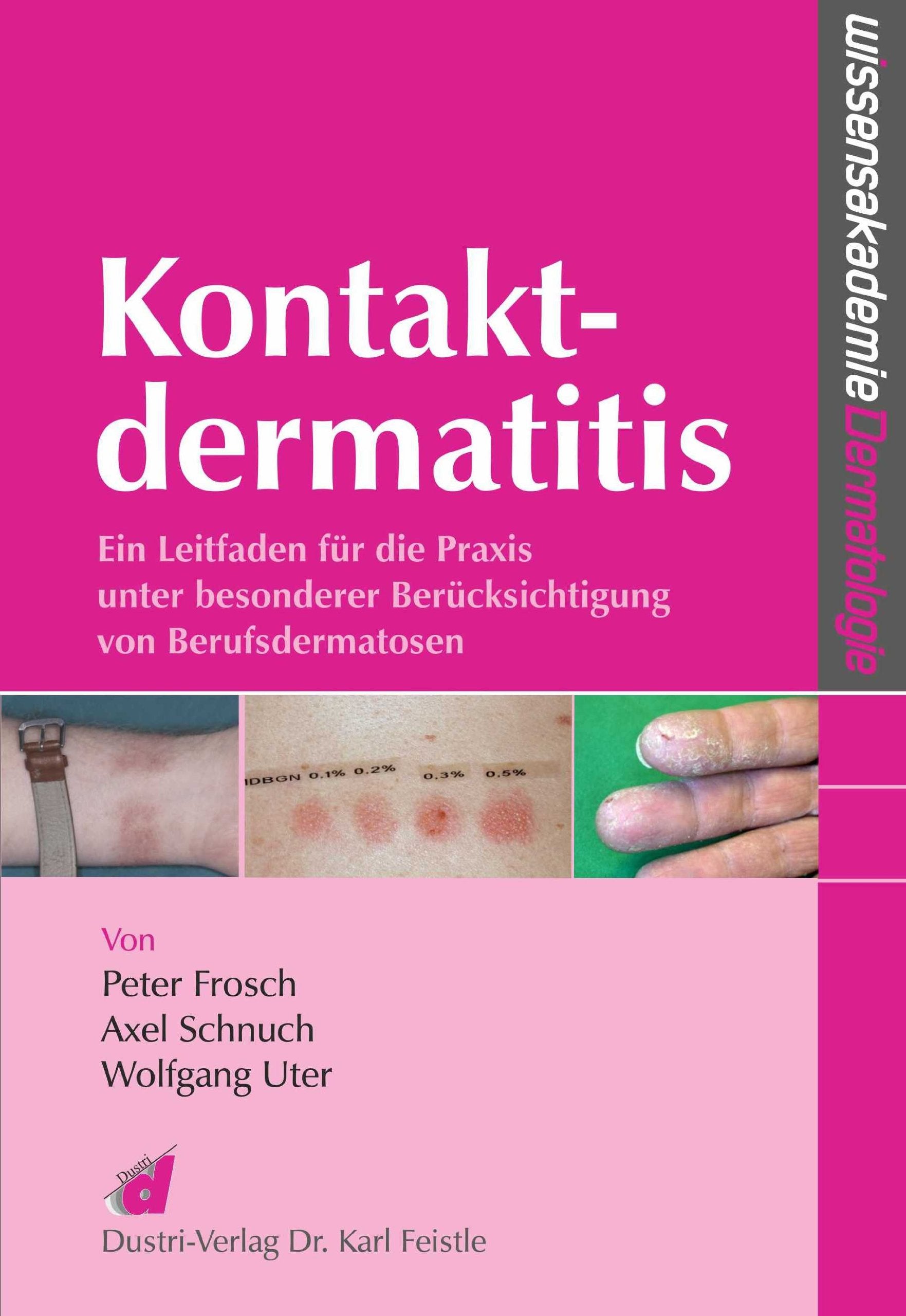 Kontaktdermatitis: Ein Leitfaden für die Praxis unter besonderer Berücksichtigung von Berufsdermatosen Medicine