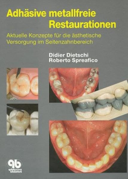 Adhäsive metallfreie Restaurationen: Aktuelle Konzepte für die ästhetische Versorgung im Seitenzahnbereich Medicine