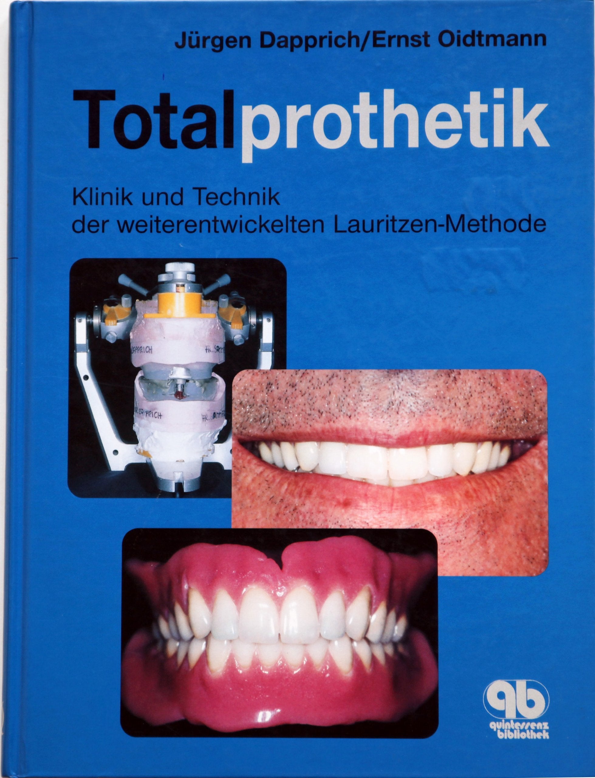 Totalprothetik: Klinik und Technik der weiterentwickelten Lauritzen-Methode Medicine