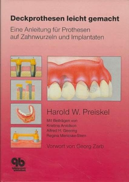 Deckprothesen leicht gemacht: Eine Anleitung für Prothesen auf Zahnwurzeln und Implantaten Medicine