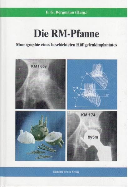 Die RM-Pfanne: Monographie eines beschichteten Hüftgelenkimplantates Medicine