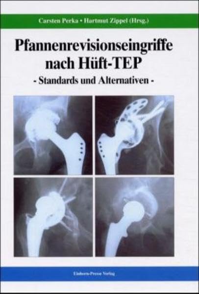 Pfannenrevisionseingriffe nach Hüft-TEP: Standards und Alternativen Medicine