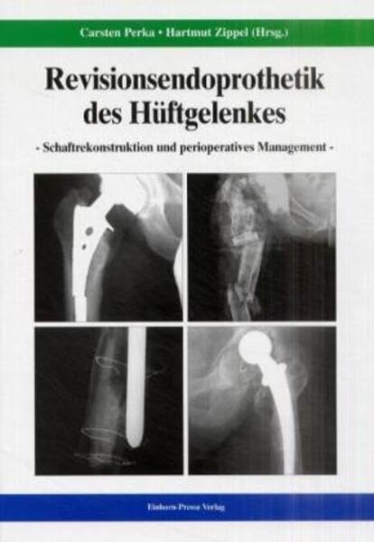 Revisionsendoprothetik des Hüftgelenks: Schaftrekonstruktion und perioperatives Management Medicine