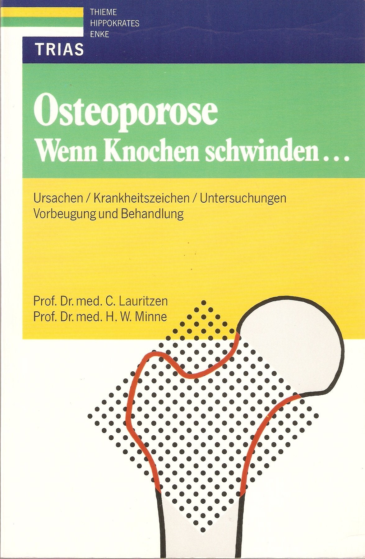Osteoporose: Wenn Knochen schwinden...: Ursachen, Krankheitszeichen, Untersuchungen. Vorbeugung und Behandlung Health, Nutrition & Fitness