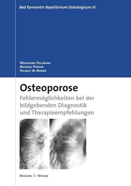 Osteoporose: Fehlermöglichkeiten bei der bildgebenden Diagnostik und Therapieempfehlungen: Fehlermöglichkeiten bei der bildgebenden Diagnostik sowie Therapieempfehlungen Medicine