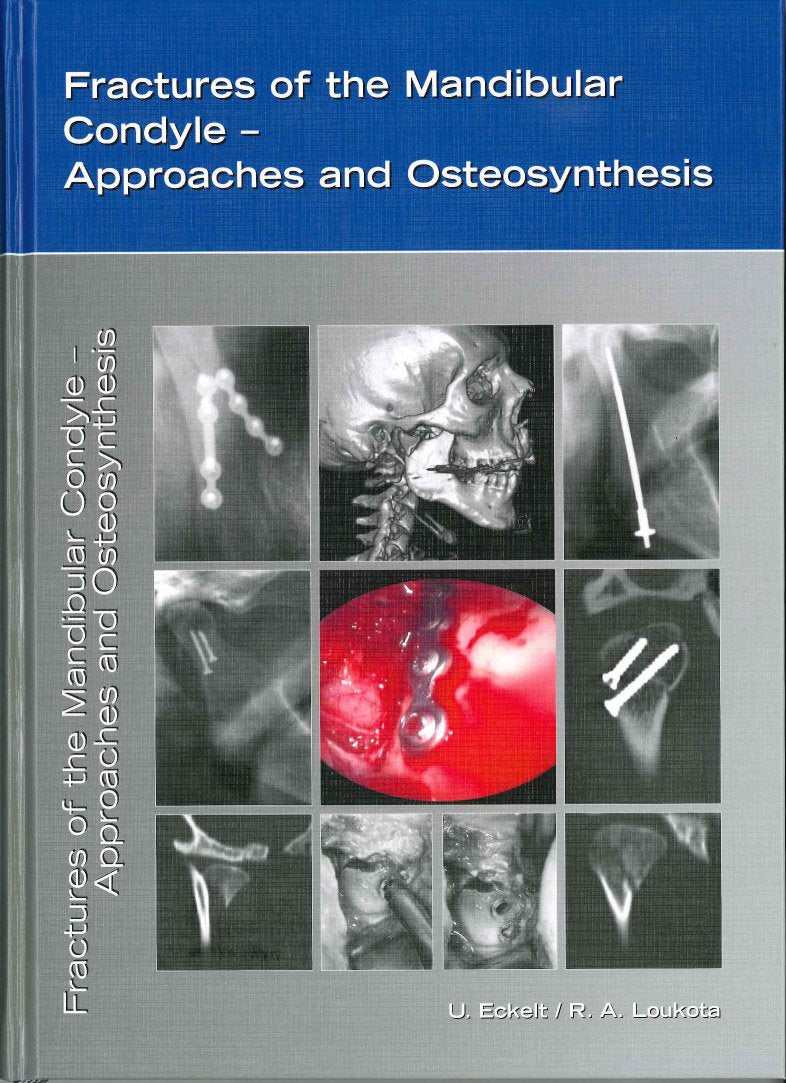 Fractures of the Mandibular Condyle: Approaches and Osteosynthesis Medicine