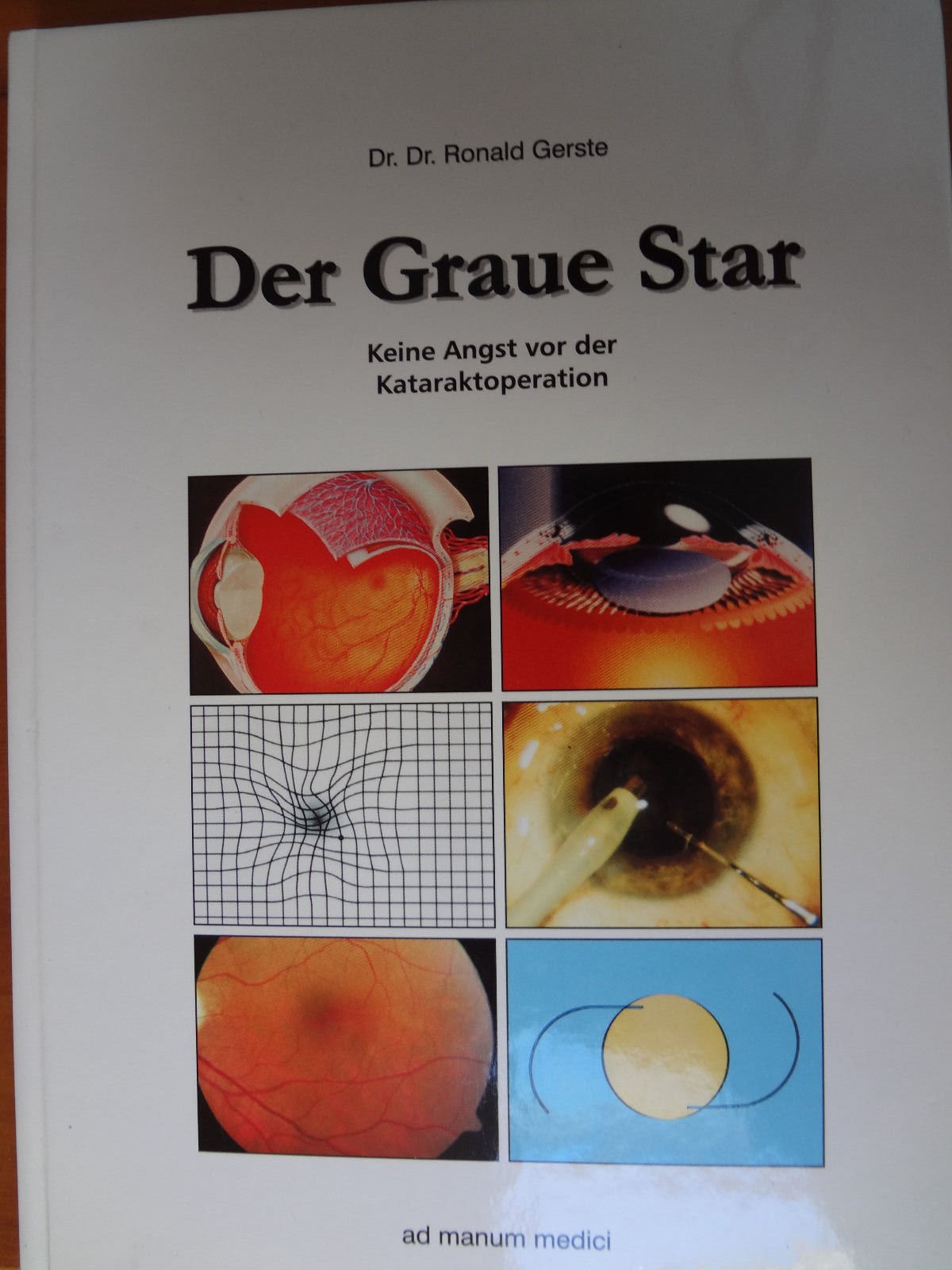 Der graue Star: Keine Angst vor der Kataraktoperation Medicine
