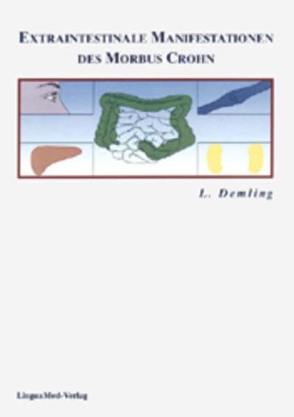 Extraintestinale Manifestationen des Morbus Crohn Medicine