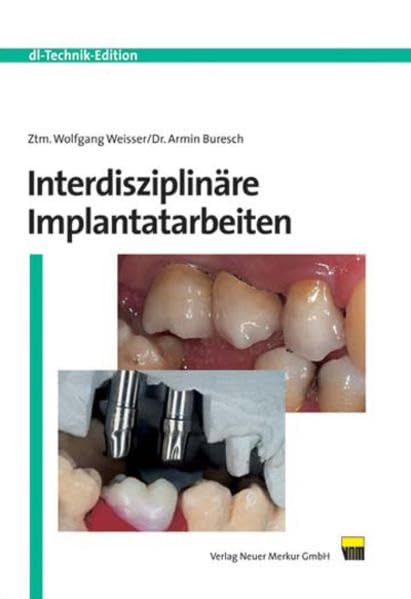 Interdisziplinäre Implantatarbeiten Medicine