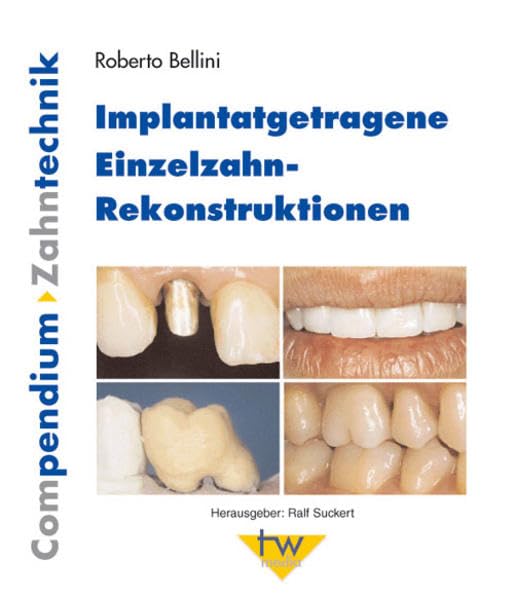 Implantatgetragene Einzelzahn-Rekonstruktionen Medicine