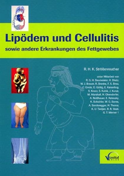 Lipödem und Cellulitis sowie andere Erkrankungen des Fettgewebes Medicine Books