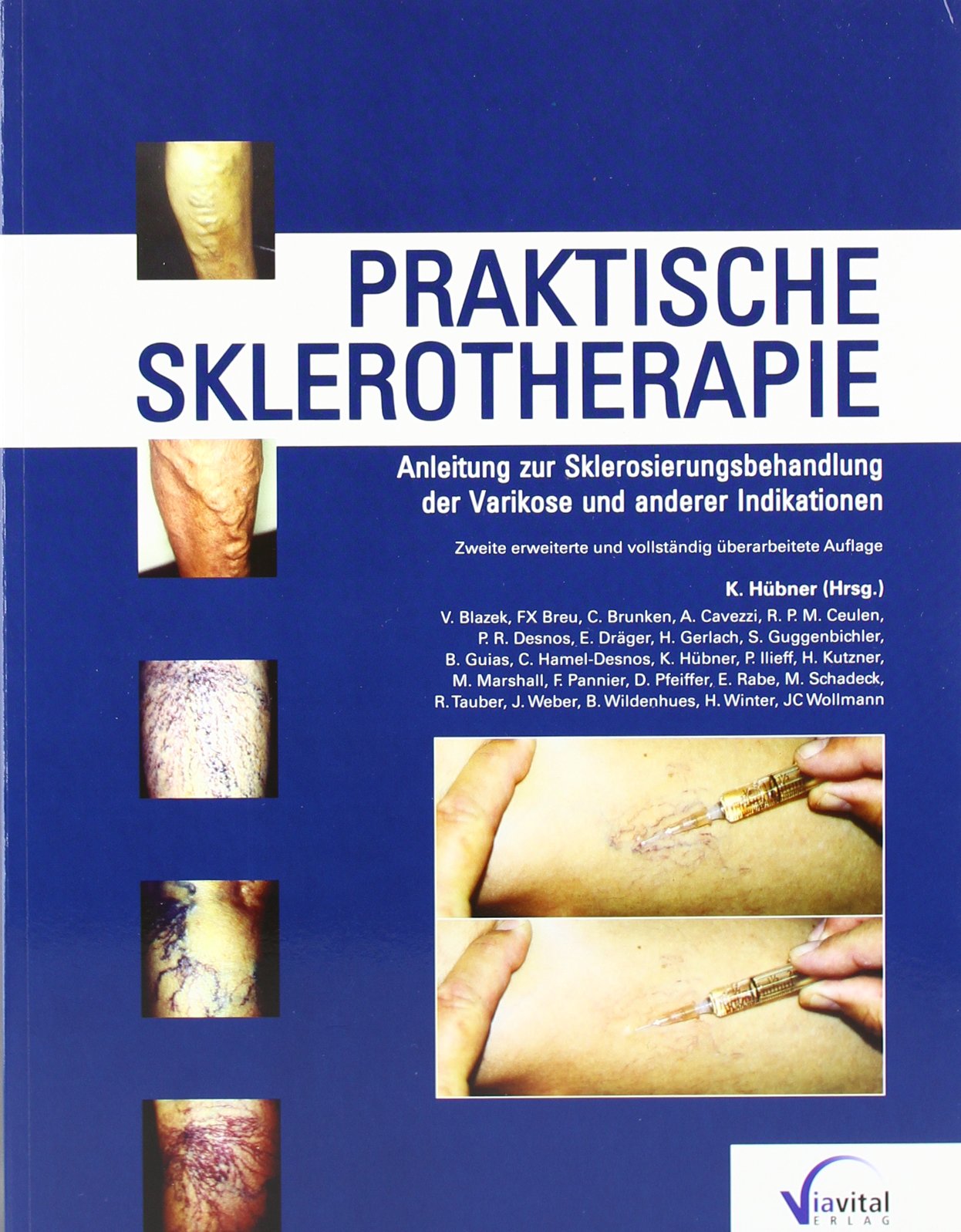 Praktische Sklerotherapie: Anleitung zur Sklerosierungsbehandlung der Varikose und anderer Indikationen Medicine