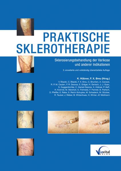Praktische Sklerotherapie: Anleitung zur Sklerosierung der Varikose und anderer Indikationen Medicine