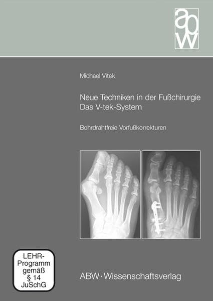 Neue Techniken in der Fußchirurgie - Das V-tek-System: Bohrdrahtfreie Vorfußkorrekturen (mit Begleit-DVD) Medicine