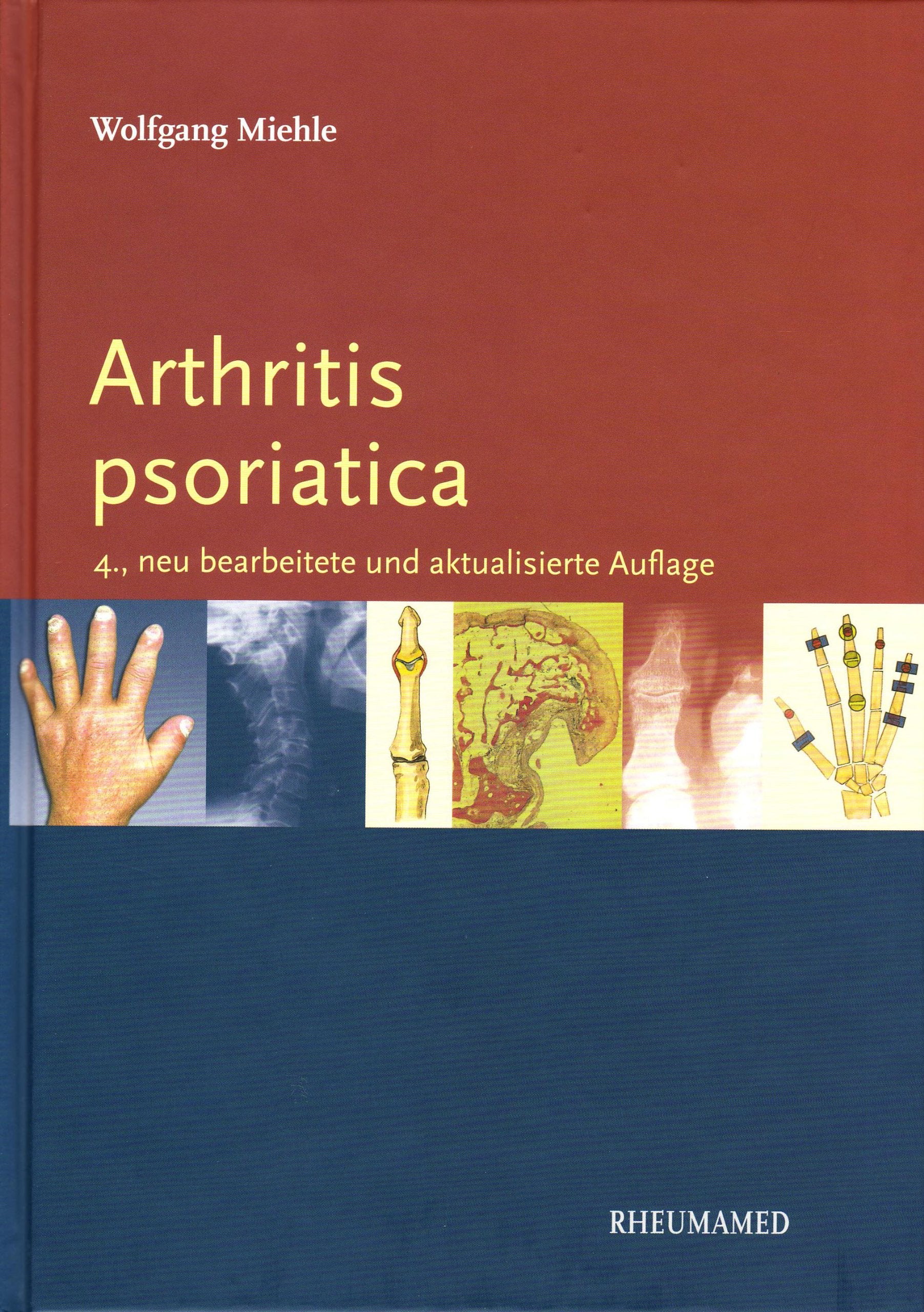 Arthritis psoriatika Medicine Books