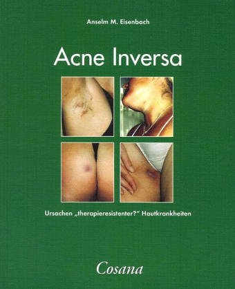 Akne inversa: Ursachen "therapieresistenter" Hautkrankheiten Medicine
