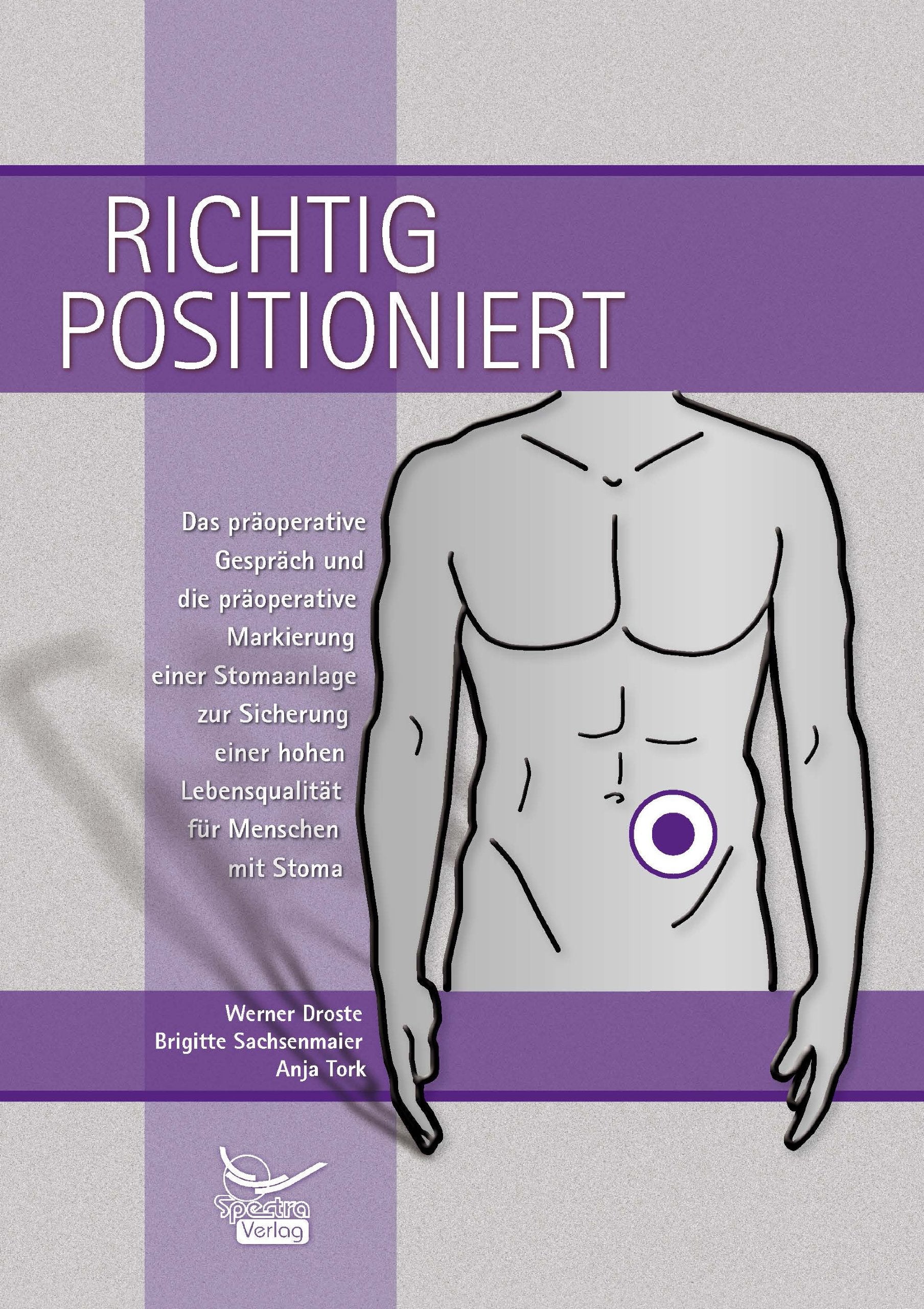 Richtig positioniert: Das präoperative Gespräch und die präoperative Markierung einer Stomaanlage zur Sicherung einer hohen Lebensqualität für Menschen mit Stoma Medicine