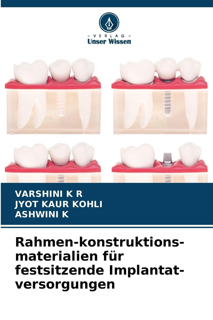 Rahmen-konstruktions-materialien für festsitzende Implantat-versorgungen Medicine