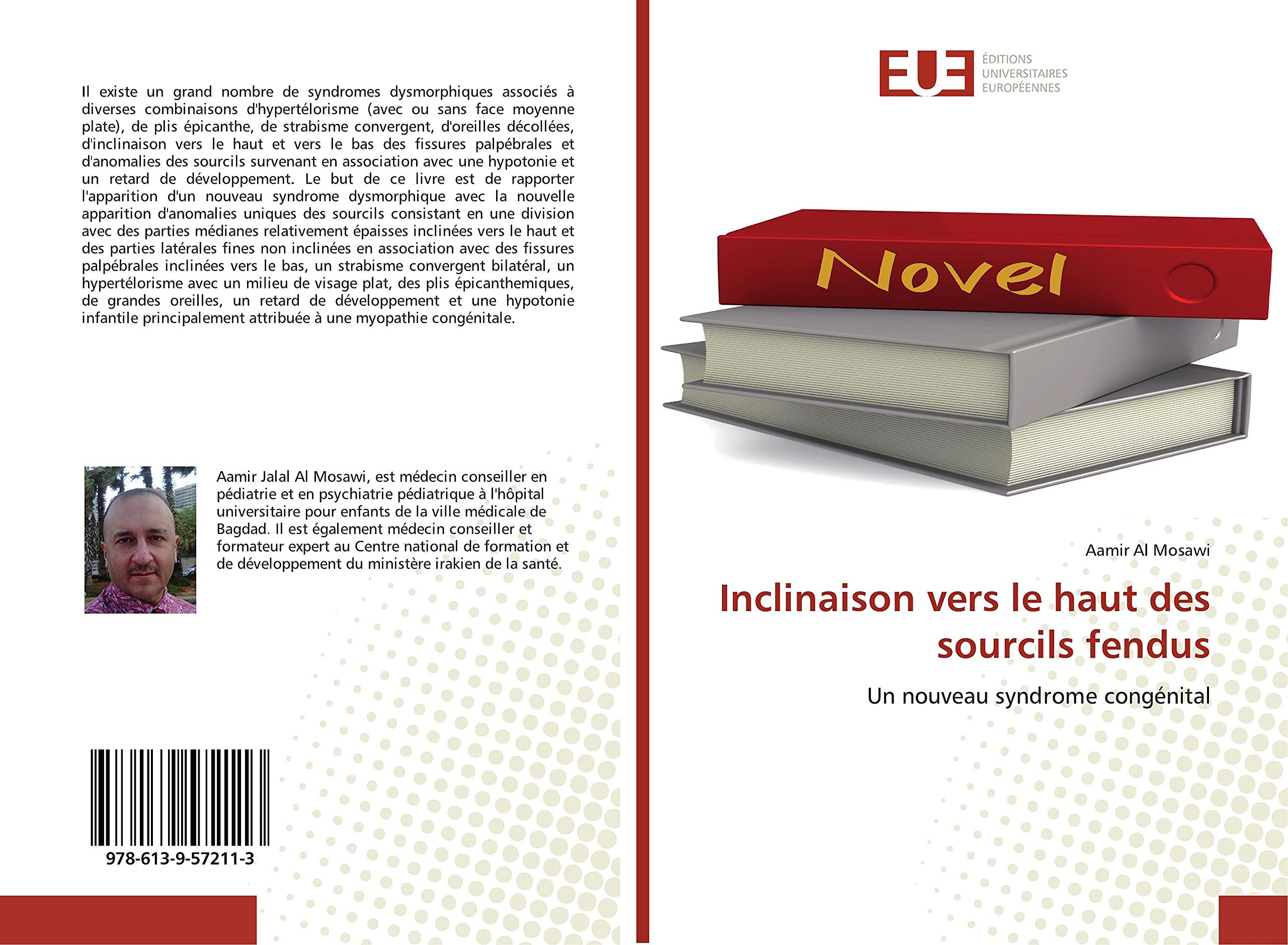 Inclinaison vers le haut des sourcils fendus: Un nouveau syndrome congénital book